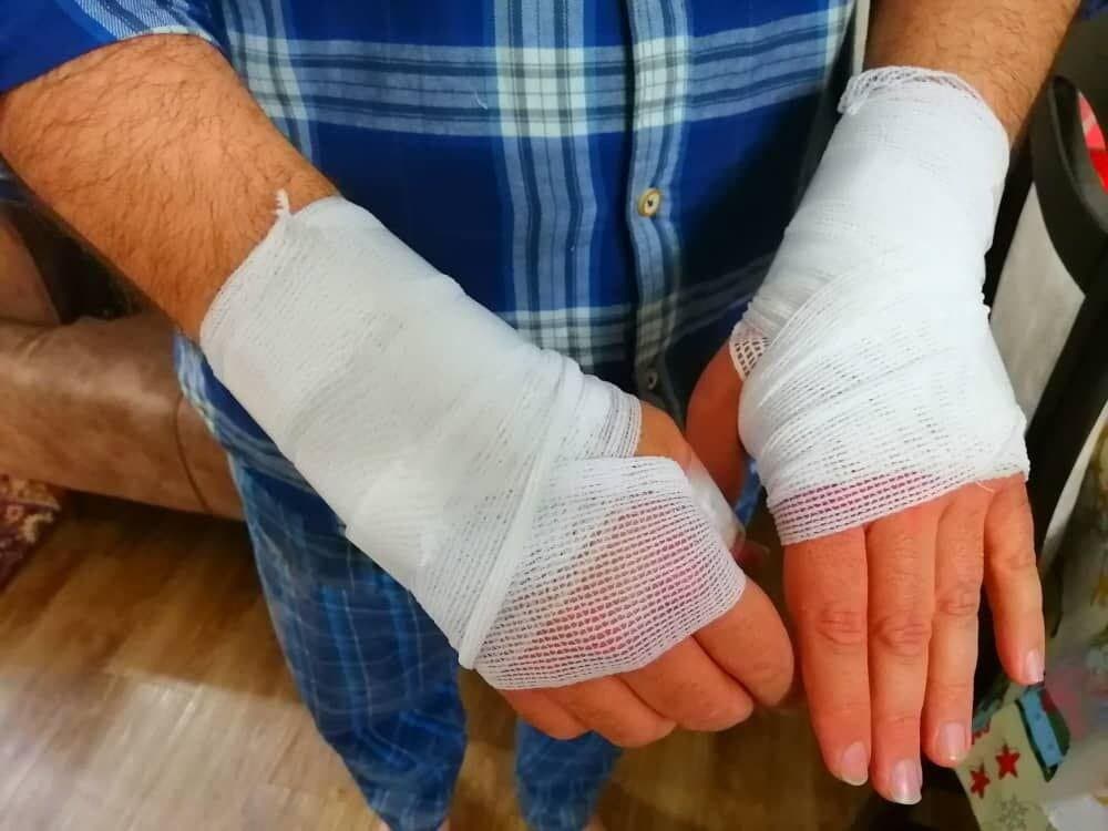 مرگ ۴۴ نفر در آذربایجان غربی بر اثر سوختگی در نیمه نخست سال