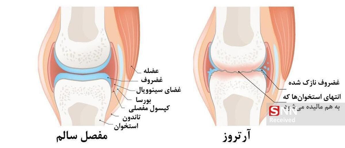 پیادهروی، دوچرخهسواری و شنا: راهکارهای مؤثر مقابله با آرتروز